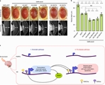 Integrated multi-omics analysis identifies epigenetic alteration related to neurodegeneration development in post-traumatic stress disorder patients. Psychiatr Genet